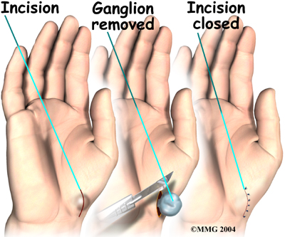 since I had never heard of a ganglion cyst until I noticed a bump on the 